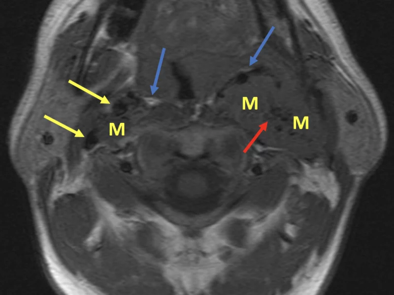 Cervical paragangliomas in a 41-year-old male. Axial T1 SE MR image immediately above the carotid bifurcation shows right and left carotid space masses (M), left larger than right. On the right, the mass is seen splaying the internal and external carotid artery flow voids (yellow arrows), characteristic of a “carotid body” glomus tumor. Note bilateral anteromedial displacement of the parapharyngeal high-signal fat (blue arrows), which confirms the carotid space location. The “salt and pepper” appearance (red arrow) is caused by black flow voids and white dots of slow flow or hemorrhage.