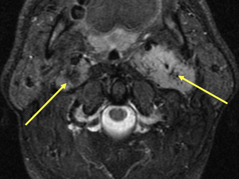 B. Axial T2 FS image at the same level as (A) demonstrates bright carotid space masses corresponding to paragangliomas. The black dots are flow voids (arrows).  