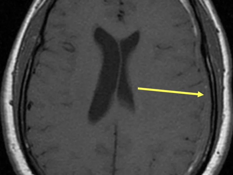 Intracranial hypotension in a 64-year-old man with a subdural hematoma and long-standing headaches. A. Axial T1 SE MR image at the level of the lateral ventricles shows an extra-axial fluid collection that is predominantly isointense to brain tissue along the left frontal and parietal lobes (arrow), representing subdural hematoma.   