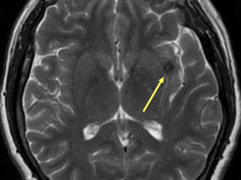 53 year old female with a cavernous malformation, associated developmental venous anomaly, and a 4-day history of dizziness. A. Axial T2 MR image at the level of the basal ganglia shows dark signal in the left insula (arrow), representing susceptibility artifact from blood in a cavernous malformation.  