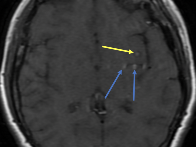 C. Axial T1 pre-contrast image shows centrally bright signal in the left insular cavernous malformation (yellow arrow) and, more posteriorly, pulsation artifact and bright signal (blue arrows), related to a developmental venous anomaly.  