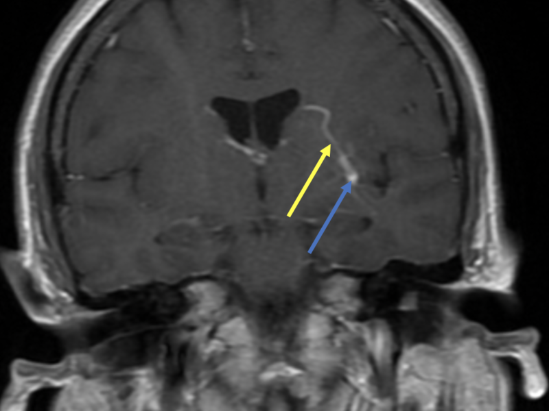 D. Coronal T1 post-contrast image shows an enhancing cavernous malformation (yellow arrow) in the left insula as well as a bright, enlarged draining vein (blue arrow), of a developmental venous anomaly.   