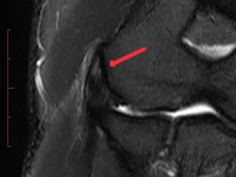 A) Coronal fat suppressed proton density image reveals thickening and increased signal intensity of the common extensor origin (red arrow).