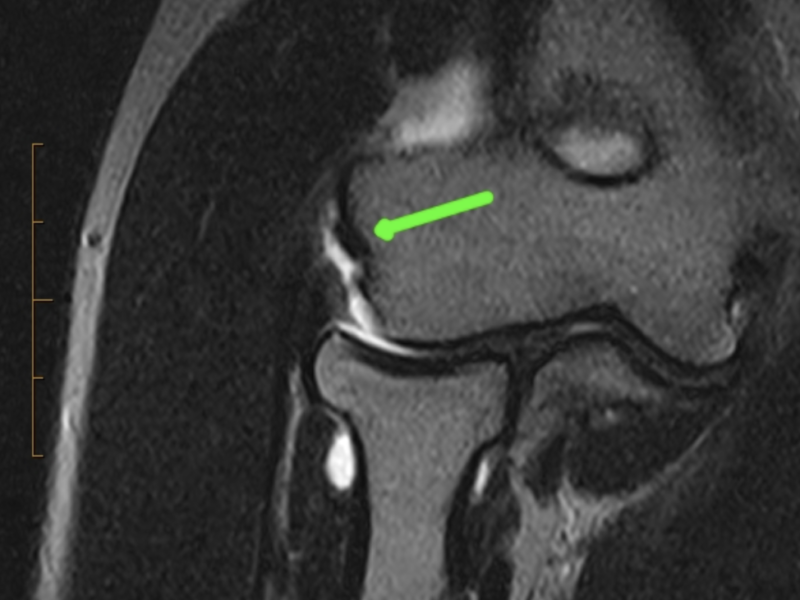 B) Coronal fat suppressed T2-weighted image reveals a fluid filled defect at the common extensor origin consistent with an undersurface partial tear (green arrow).