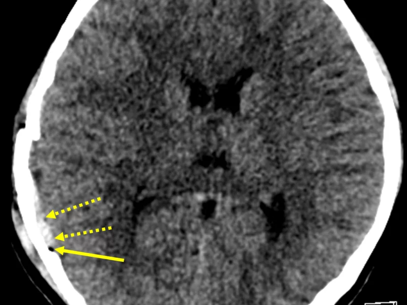 C. Axial CT at the same level as (A) with brain windowing shows pneumocephalus (solid arrow) and a curvilinear extra-axial high density collection (dashed arrows) consistent with a small subdural hematoma. The presence of pneumocephalus indicates a compound/open fracture. Gray-white differentiation is preserved.
