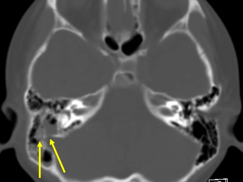 D. Axial CT at a level inferior to (A) with bone windowing shows a longitudinal fracture through the mastoid part of the temporal bone (arrows) with fluid in the mastoid air cells and middle ear. No ossicular disruption is seen.