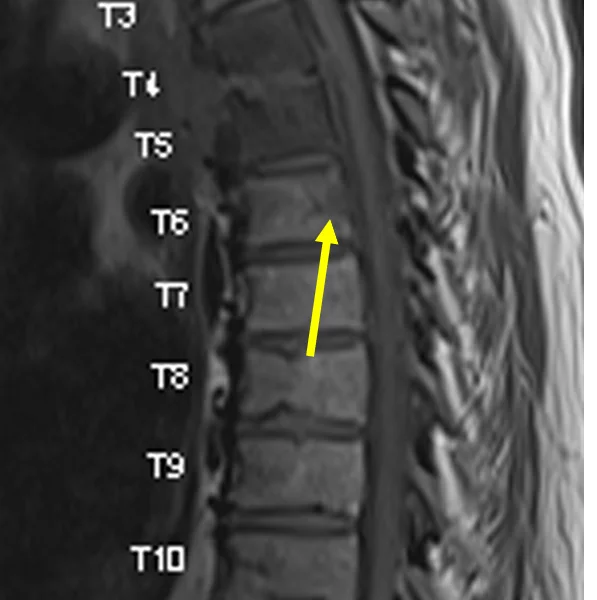 Spinal epidural abscess in a 57-year-old man with back pain and bacteremia. A. Sagittal T1 TSE MR image shows abnormal low signal within the T4 and T5 vertebral bodies and the T4-5 disc space, as well as destructive end plate changes at T4 and T5, consistent with vertebral discitis-osteomyelitis. There is also an area of low signal within the posterior aspect of T6 (arrow).