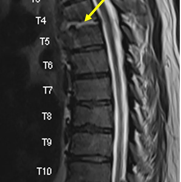 B. Sagittal T2 TSE image at the same level as (A) shows heterogeneous signal within the T4 and T5 vertebral bodies and T4-5 disc space (arrow), and endplate erosion.