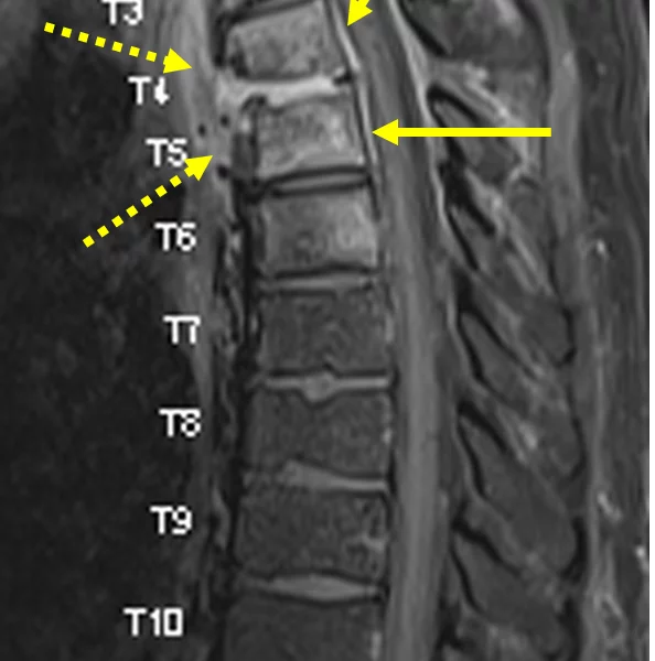 C. Sagittal T1 TSE fat saturated image with contrast at the same level as (A) shows enhancement of the T4-T6 vertebral bodies and the T4-5 disc space. There is also smooth, linear enhancement of the epidural space (arrows), consistent with a spinal epidural abscess. The anterior paraspinal phlegmon also enhances (dashed arrows).