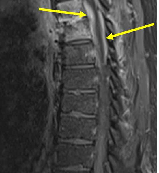 D. Sagittal T1 TSE fat saturated image with contrast at a level lateral to (A) shows the enhancing abscess extending into the anterior and posterior epidural spaces (arrows), wrapping around the thoracic cord from T4 down through T6.