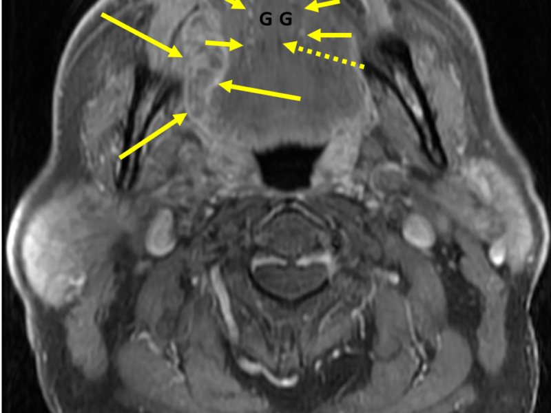 Squamous cell carcinoma of the right tongue in a 62-year-old man. A. Axial T1 FSE fat saturated MR image with contrast shows a 4.3 cm heterogeneously enhancing mass (solid long arrows) in the right lateral tongue and floor of the mouth. The mass does not cross the midline. The hypointense fatty lingual septum (dashed arrow), marking the midline floor of the mouth, is intact. Paired genioglossus (G) muscles are lateral to the septum. The sublingual space containing the neurovascular bundles (solid short arrows) is lateral to the genioglossus mm.