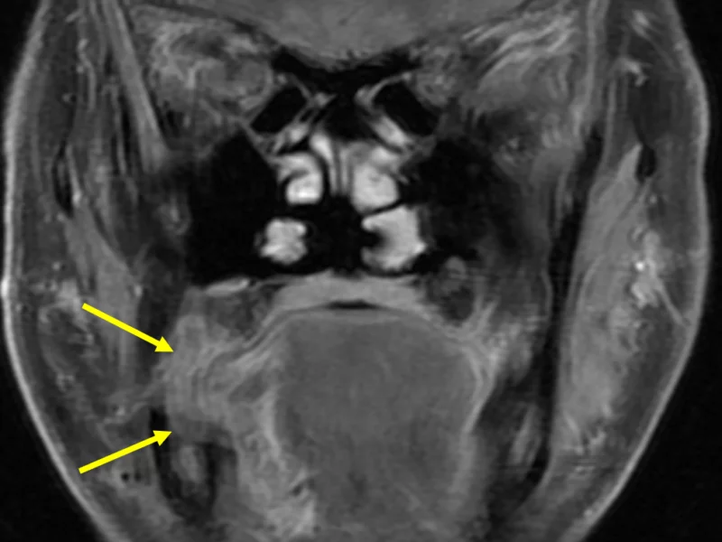 B. Coronal T1 FSE fat saturated image with contrast shows the tumor extending laterally (arrows), invading and eroding the right mandible.