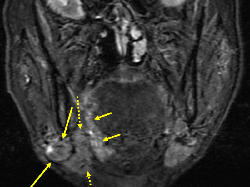 D. Coronal T2 STIR image at a level posterior to (C) shows a 2.3 cm enlarged node (solid long arrows) adjacent to but not invading the right submandibular gland (dashed arrows), and lateral to the enhancing tumor (short arrows).