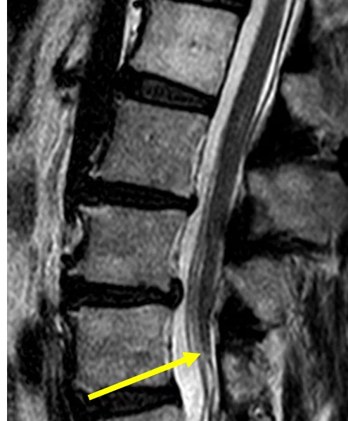 Tethered cord in a 57-year-old woman with low back pain since childhood, worsening over the past 2 years, and left leg pain and numbness. A. Sagittal T2-weighted MR image shows low positioning of the conus medullaris (arrow) at L5.
