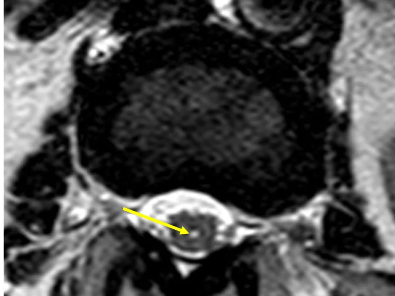 B. Axial DISC T2 image shows a small area of high signal within the cord (arrow) at the L2-3 disc level, consistent with a syrinx.