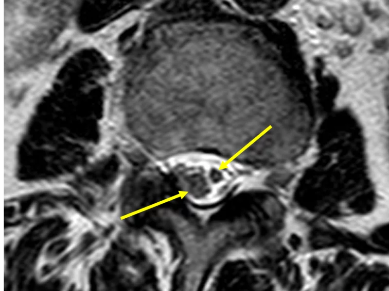 C. Axial DISC T2 image at a level inferior to (B) shows asymmetric splitting of the spinal cord (arrows), consistent with type 2 diastematomyelia (i.e., single dural sac containing both hemicords and no bony septum).