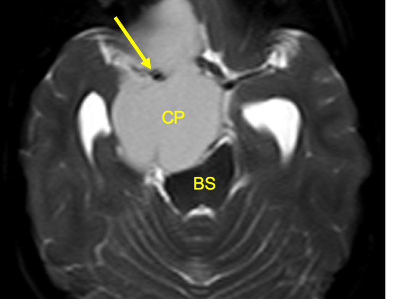 A: Axial SSH TSE non-contrast enhanced MRI shows a homogeneous, circumscribed, extra axial, chiasmic and suprasellar high signal mass (CP) encasing the right cerebral vasculature (arrow) and compressing the brainstem (BS).