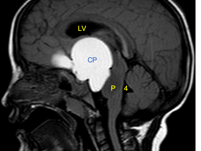 B: Sagittal T2 FLAIR image shows a markedly bright mass (CP) compressing the pons (P) posteriorly. The visulized lateral ventricle (LV) is distended due to obstructive hydrocephalus and the 3rd ventricle is not visualized. The aqueduct and 4th ventricle (4) are normal in size.