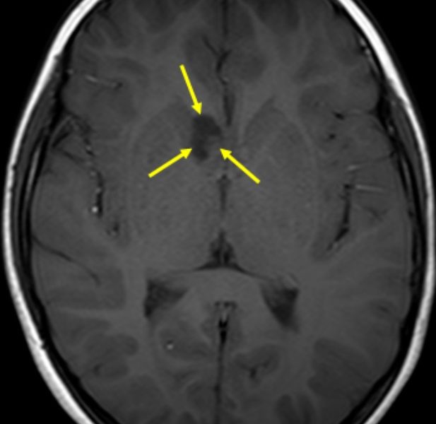 Tuberous sclerosis complex in an 8-year-old boy with seizures. A: Axial T1-weighted MR image without contrast shows a mixed cystic/solid mass bordering the foramen of Monro (arrows). 