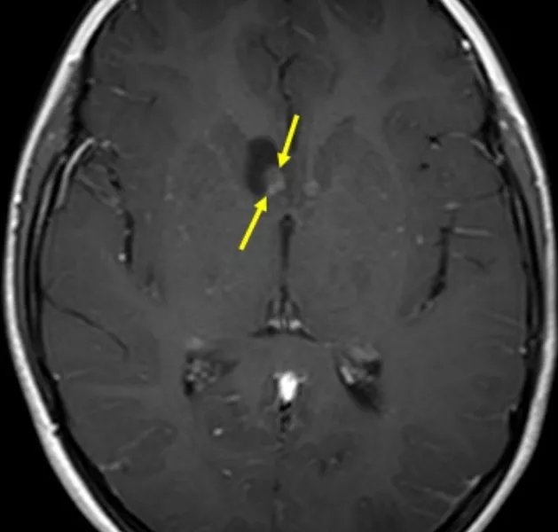 B: Axial T1 image post contrast shows nodular enhancement of the solid portion of the mass (arrow). The mass had enlarged compared with prior exams  consistent with subependymal nodule degeneration into a subependymal giant cell astrocytoma.