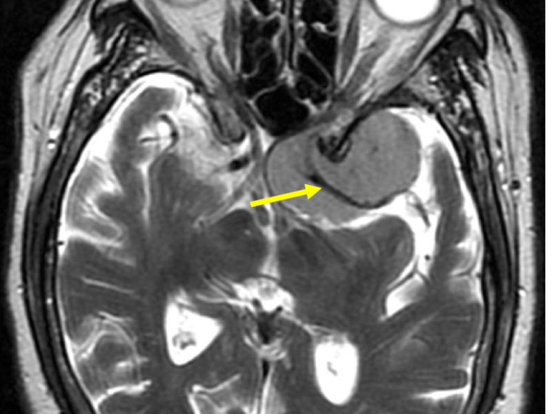 Left anterior and middle cranial fossa meningioma in a 85-year-old woman with memory loss. A: Axial T2-weighted image at the level of the lateral ventricles shows a well-demarcated, homogeneous mass (M), hyperintense to brain, that effaces the lateral ventricles and causes mild righward subfalcine herniation (arrow). B: Axial T2 image inferior to (A) shows encasement of the left cerebral vasculature (arrow). C and D: Coronaal T2 images show effacement of the frontal horn of the left lateral ventricle (FH) and encasement of the left anterior and middle cerebral anteries (arrows). There is also nonspecific cerebral volume loss.