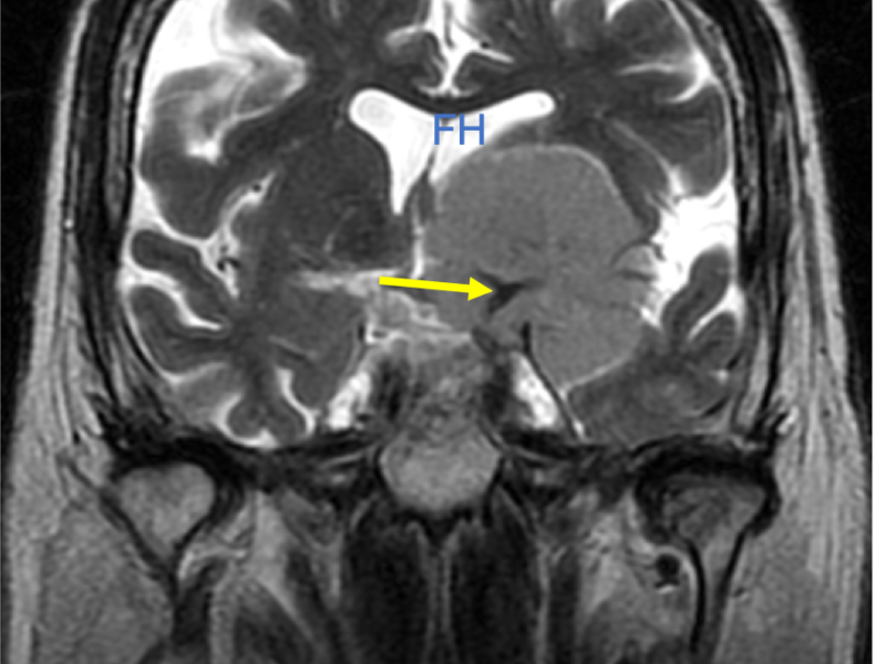 Left anterior and middle cranial fossa meningioma in a 85-year-old woman with memory loss. A: Axial T2-weighted image at the level of the lateral ventricles shows a well-demarcated, homogeneous mass (M), hyperintense to brain, that effaces the lateral ventricles and causes mild righward subfalcine herniation (arrow). B: Axial T2 image inferior to (A) shows encasement of the left cerebral vasculature (arrow). C and D: Coronaal T2 images show effacement of the frontal horn of the left lateral ventricle (FH) and encasement of the left anterior and middle cerebral anteries (arrows). There is also nonspecific cerebral volume loss.
