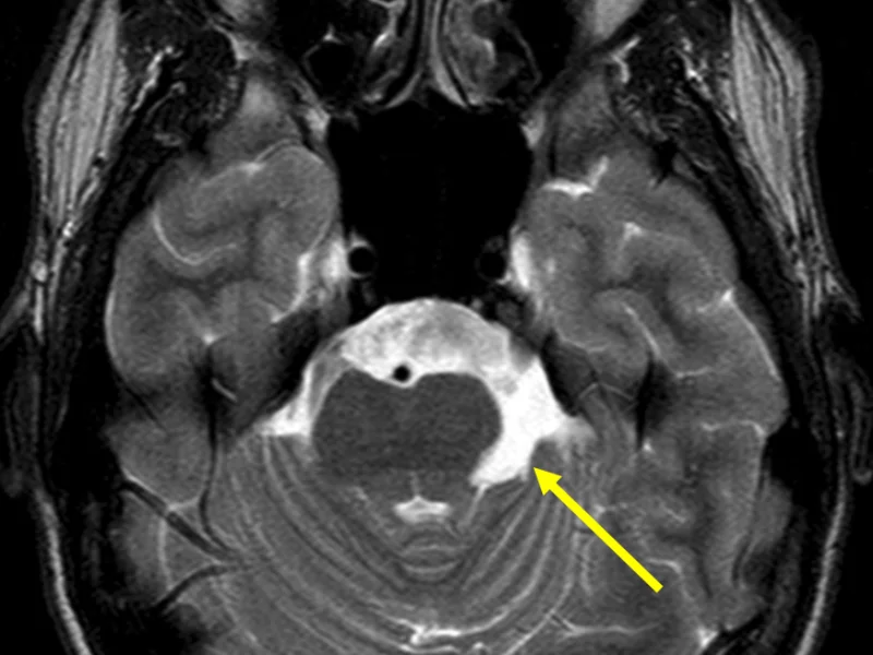 Residual epidermoid cyst in a 27-year-old man with prior epidermoid cyst resection. A. Axial T2-weighted MR image at the level of the upper pons shows asymmetric enlargement of the left ambient cistern (arrow).