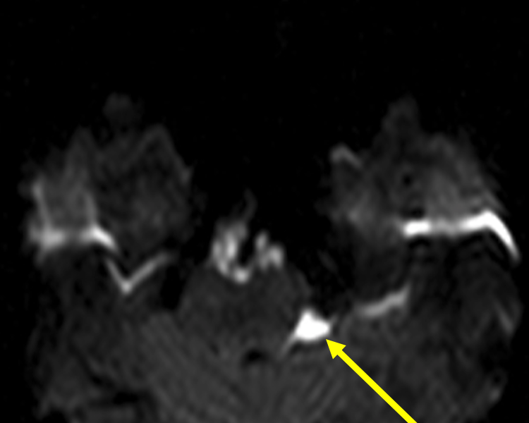 C. Axial diffusion weighted image (DWI) shows restricted diffusion (arrow), seen as high signal on DWI sequence (other than B0 series), and corresponding to dark signal on the ADC map.