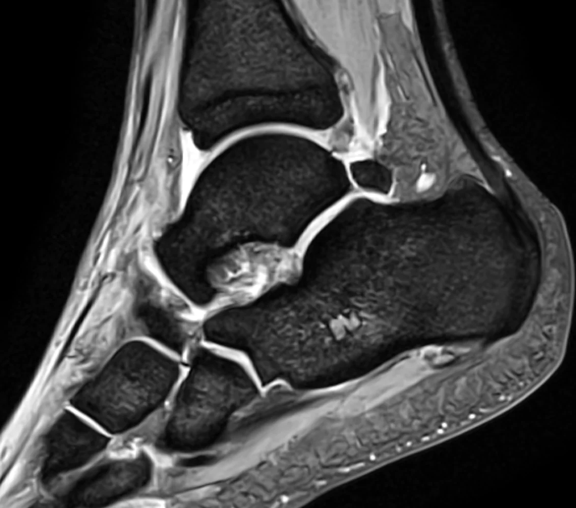 Lateral ankle sprain