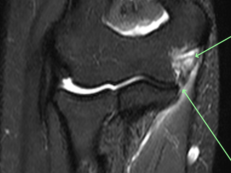 Ulnar Collateral Ligament Ucl Tear Diagnosis Mri Online
