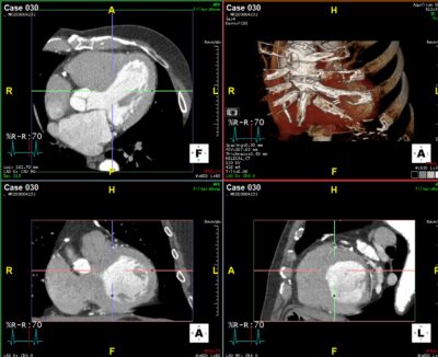 Cardiac CT Terarecon
